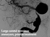 imaging of large carotid terminus aneurysm, prior to treatment