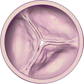 Aortic Valve - Diseased (Mild): Closed