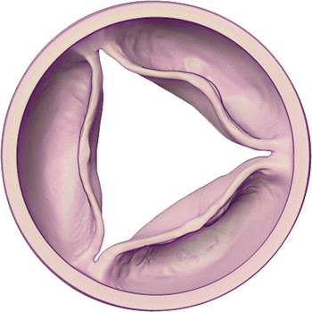 Aortic Valve - Diseased (Mild): Open