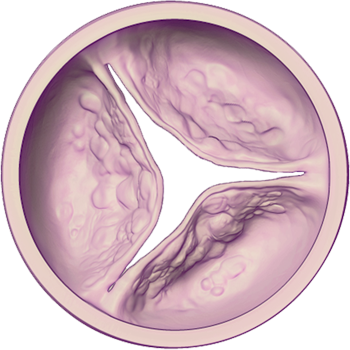 Aortic Valve - Diseased (Moderate): Closed