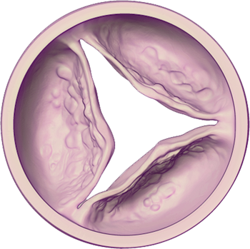 Aortic Valve - Diseased (Moderate): Open