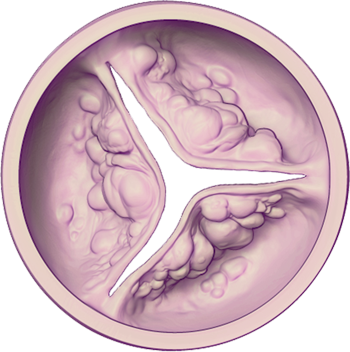 Aortic Valve - Diseased (Severe): Closed