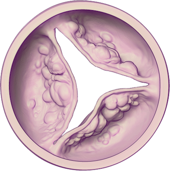 Aortic Valve - Diseased (Severe): Open